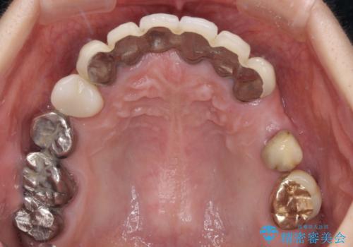 放置したインプラントとインビザライン 全顎リカバリー治療の治療前