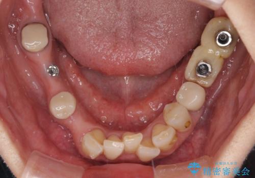 放置したインプラントとインビザライン 全顎リカバリー治療の治療前