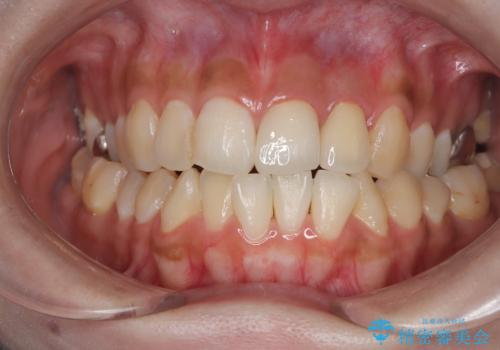 前歯の歯茎の黒ずみと被せ物の形と色が気になる【オールセラミッククラウン】の治療後