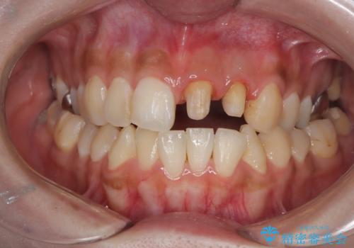 前歯の歯茎の黒ずみと被せ物の形と色が気になる【オールセラミッククラウン】の治療後