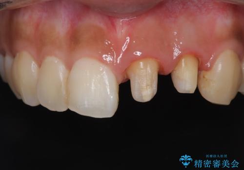 前歯の歯茎の黒ずみと被せ物の形と色が気になる【オールセラミッククラウン】の治療後