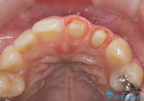 前歯の歯茎の黒ずみと被せ物の形と色が気になる【オールセラミッククラウン】の治療後