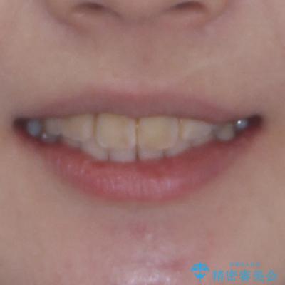 デコボコと深い咬み合わせ　ワイヤー装置での抜歯矯正の治療後（顔貌）
