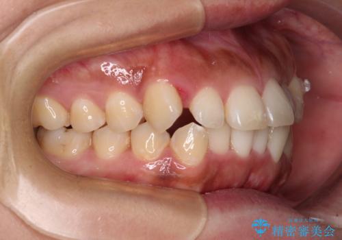 【モニター】カリエール・ディスタライザーを併用した八重歯のインビザライン矯正 の治療中