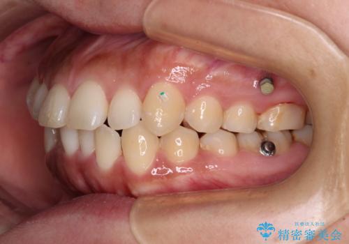 【モニター】カリエール・ディスタライザーを併用した八重歯のインビザライン矯正 の治療中