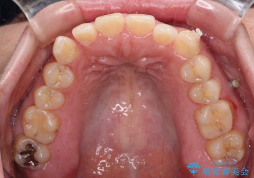 【モニター】カリエール・ディスタライザーを併用した八重歯のインビザライン矯正 の治療中