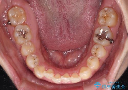 【モニター】カリエール・ディスタライザーを併用した八重歯のインビザライン矯正　の治療中