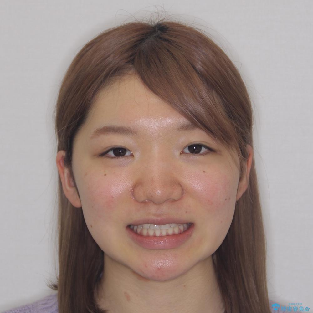 【モニター】短期間で終わりたい ワイヤー装置での非抜歯矯正の治療後(顔貌)