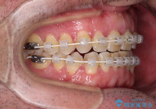 前歯でものを噛みきりたい　目立たない装置でのワイヤー矯正の治療中