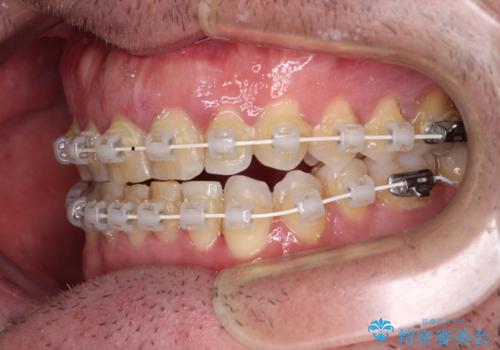 前歯でものを噛みきりたい 目立たない装置でのワイヤー矯正の治療中