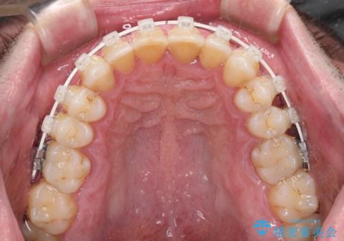 前歯でものを噛みきりたい 目立たない装置でのワイヤー矯正の治療中
