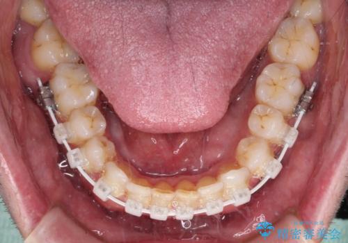 前歯でものを噛みきりたい　目立たない装置でのワイヤー矯正の治療中
