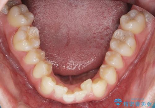 [ 下顎臼歯遠心移動 ] 受け口傾向のマウスピース矯正の治療前