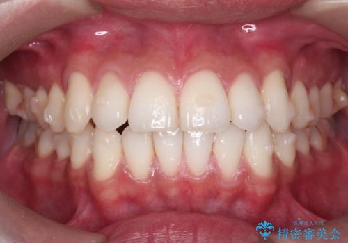 突出した前歯を改善! マウスピース治療の治療中