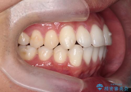 突出した前歯を改善! マウスピース治療の治療中