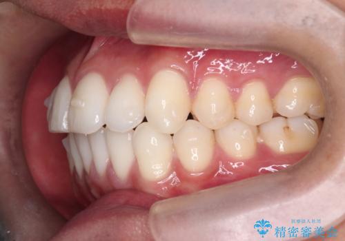 突出した前歯を改善! マウスピース治療の治療中