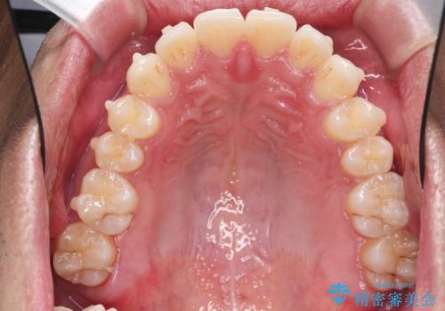 突出した前歯を改善! マウスピース治療の治療中