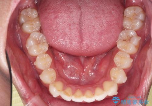 突出した前歯を改善! マウスピース治療の治療中