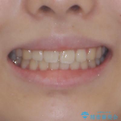 インビザラインは使える自信がない ワイヤー装置にて矯正治療の治療後(顔貌)