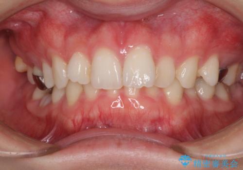 インビザラインによる矯正治療と奥歯のインプラント治療の症例 治療前