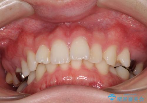 インビザラインによる矯正治療と奥歯のインプラント治療の治療前