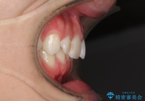 インビザラインによる矯正治療と奥歯のインプラント治療の治療前