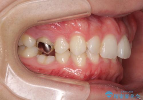 インビザラインによる矯正治療と奥歯のインプラント治療の治療前
