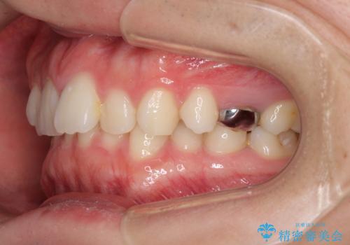 インビザラインによる矯正治療と奥歯のインプラント治療の治療前