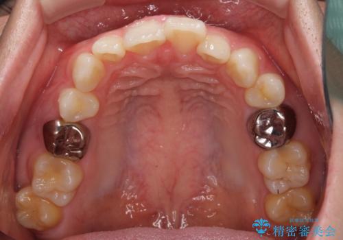 インビザラインによる矯正治療と奥歯のインプラント治療の治療前
