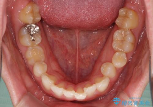 インビザラインによる矯正治療と奥歯のインプラント治療の治療前