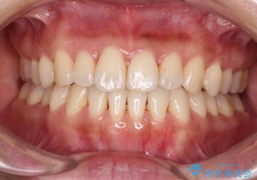 【モニター】前歯のデコボコをインビザラインで改善の治療中