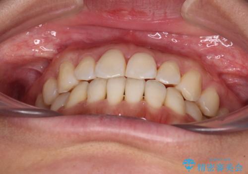 【モニター】前歯のデコボコをインビザラインで改善の治療中