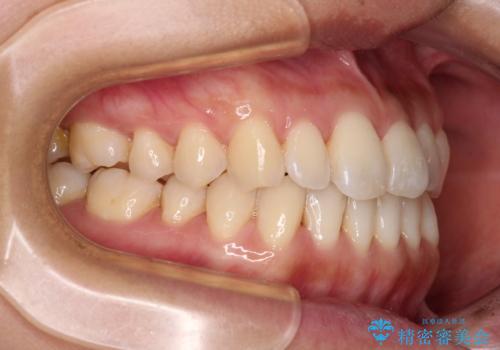 【モニター】前歯のデコボコをインビザラインで改善の治療中
