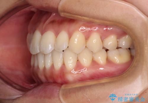 【モニター】前歯のデコボコをインビザラインで改善の治療中