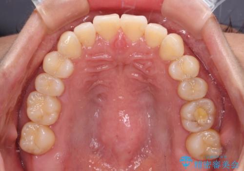 【モニター】前歯のデコボコをインビザラインで改善の治療中