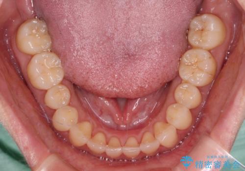 【モニター】前歯のデコボコをインビザラインで改善の治療中