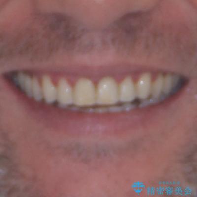 前歯でものを噛みきりたい 目立たない装置でのワイヤー矯正の治療後(顔貌)