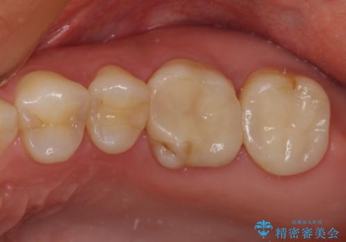 奥歯がズキズキと痛む　奥歯の虫歯治療の治療前
