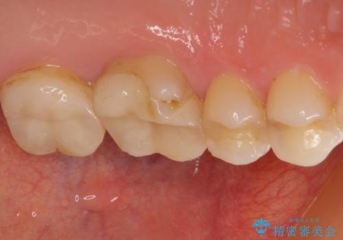 奥歯がズキズキと痛む 奥歯の虫歯治療の治療前