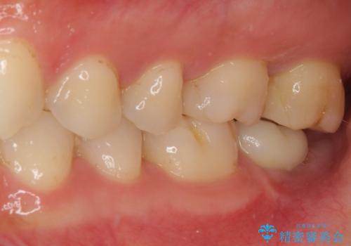 奥歯がズキズキと痛む 奥歯の虫歯治療の治療前