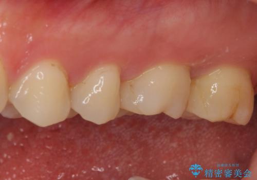 奥歯がズキズキと痛む 奥歯の虫歯治療の治療前