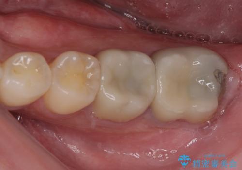 海外赴任前に治したい 割れてしまった奥歯のオールセラミッククラウンの症例 治療前