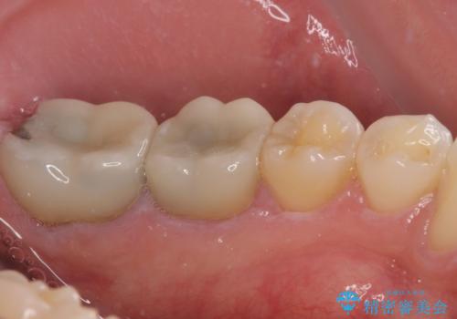 海外赴任前に治したい 割れてしまった奥歯のオールセラミッククラウンの治療前