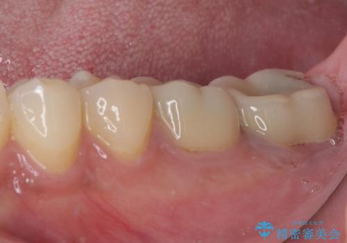 海外赴任前に治したい 割れてしまった奥歯のオールセラミッククラウンの治療前