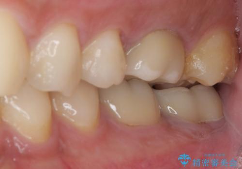 海外赴任前に治したい 割れてしまった奥歯のオールセラミッククラウンの治療前