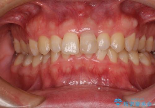 変色した前歯をオールセラミッククラウンにの治療前