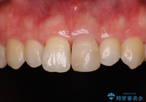 変色した前歯をオールセラミッククラウンにの治療前