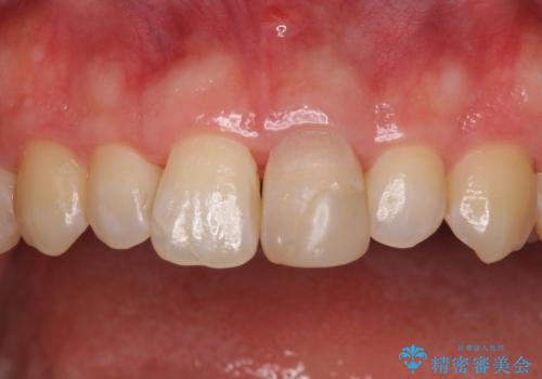 変色した前歯をオールセラミッククラウンにの治療前