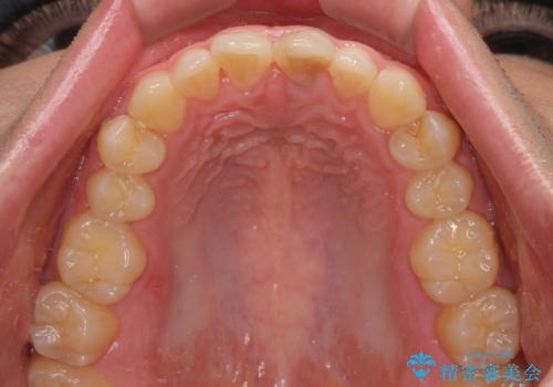 変色した前歯をオールセラミッククラウンにの治療前