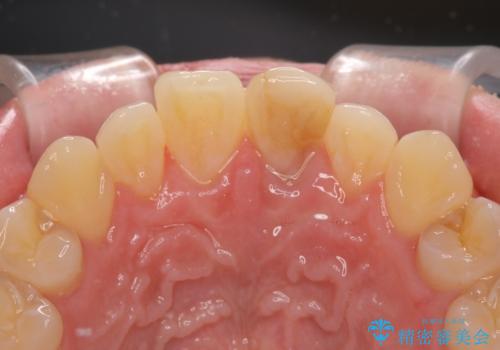 変色した前歯をオールセラミッククラウンにの治療前